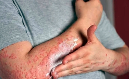 Salta confirmó 11 casos activos de lepra y hay alerta sanitaria en la vecina provincia